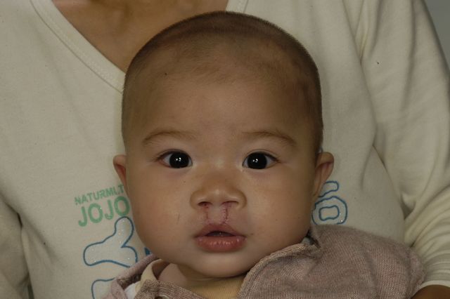 cleft lip before and after. Baojing Lai, Age 1, Before